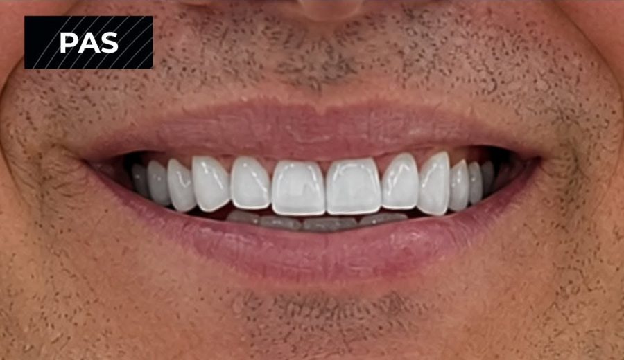 After treatment, Worn and damaged upper teeth restored with crowns, Dental Oasis Tirana