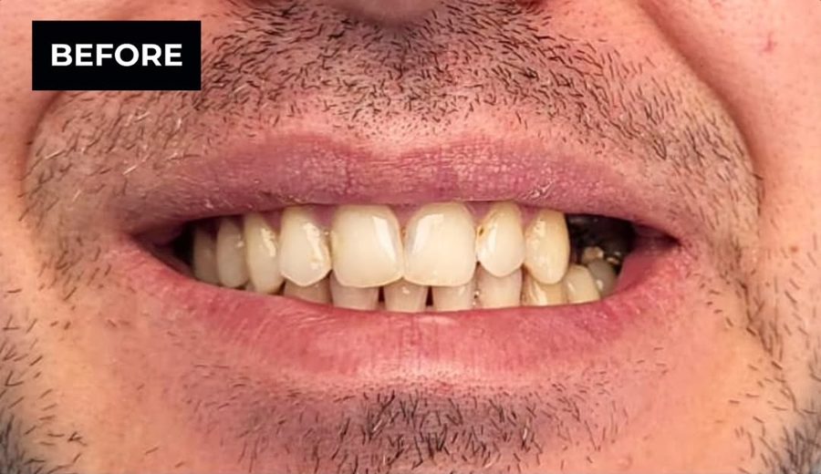 Before treatment, Stained enamel cleaned, whitened and polished, Dental Oasis Tirana