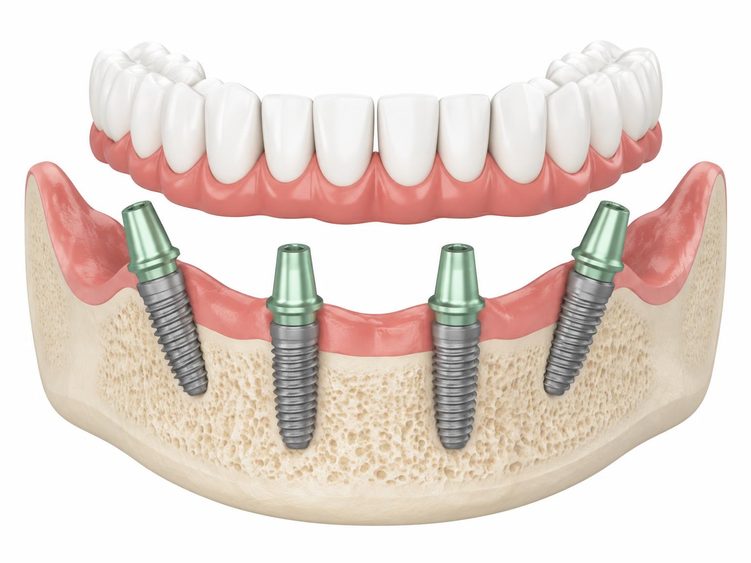 Illustration of a full-arch bridge being fitted onto four implants