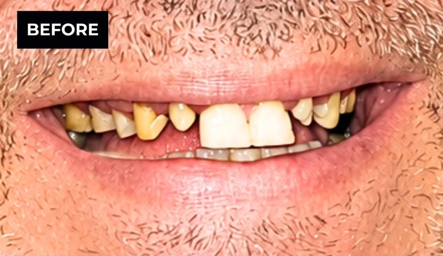 Before treatment, Heavily worn and decayed teeth rebuilt with zirconia crowns, Dental Oasis Tirana