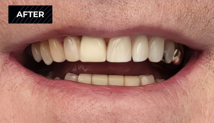 After treatment, Failing upper arch replaced with a fixed full-arch bridge, Dental Oasis Tirana