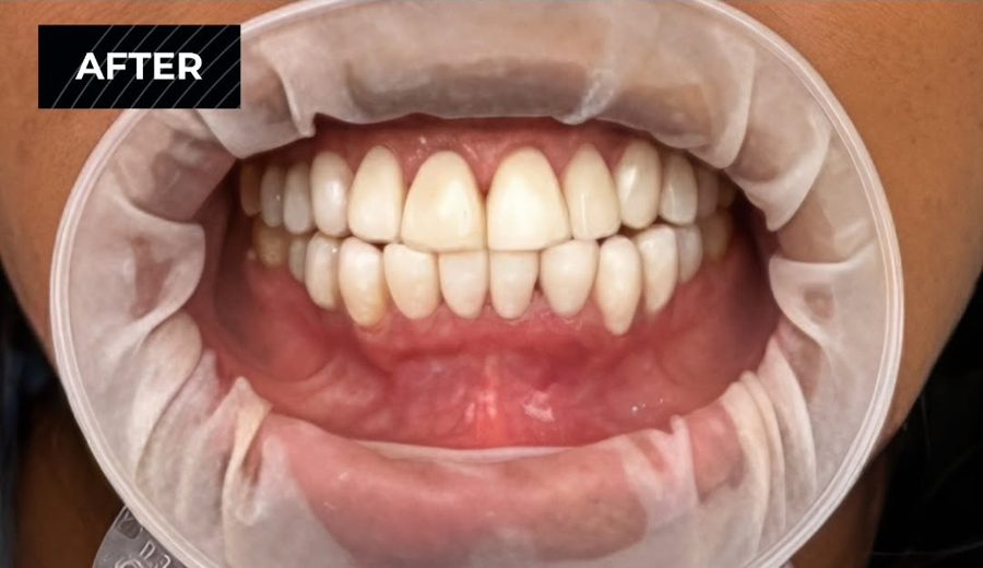 After treatment, Old metal crown swapped for a natural ceramic one, Dental Oasis Tirana