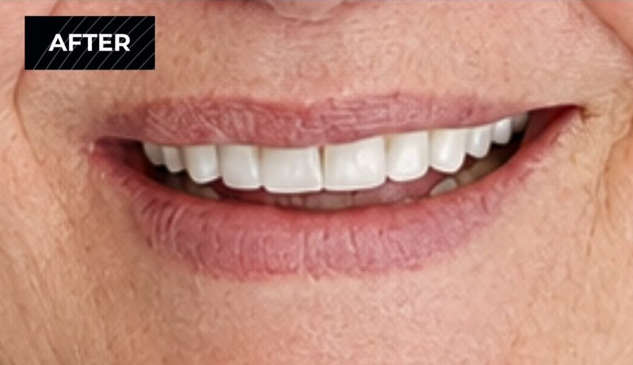 After treatment, Gaps and worn edges closed with a full veneer set, Dental Oasis Tirana