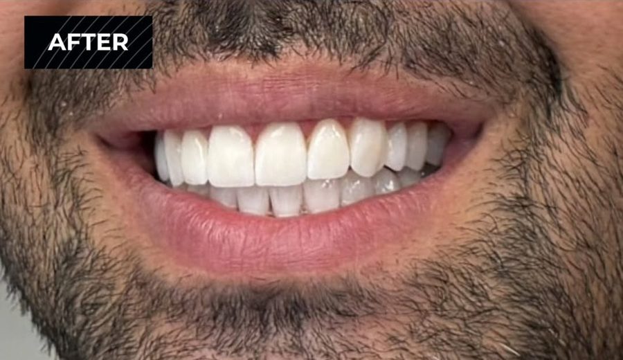 After treatment, Yellowed smile brightened and evened out, Dental Oasis Tirana