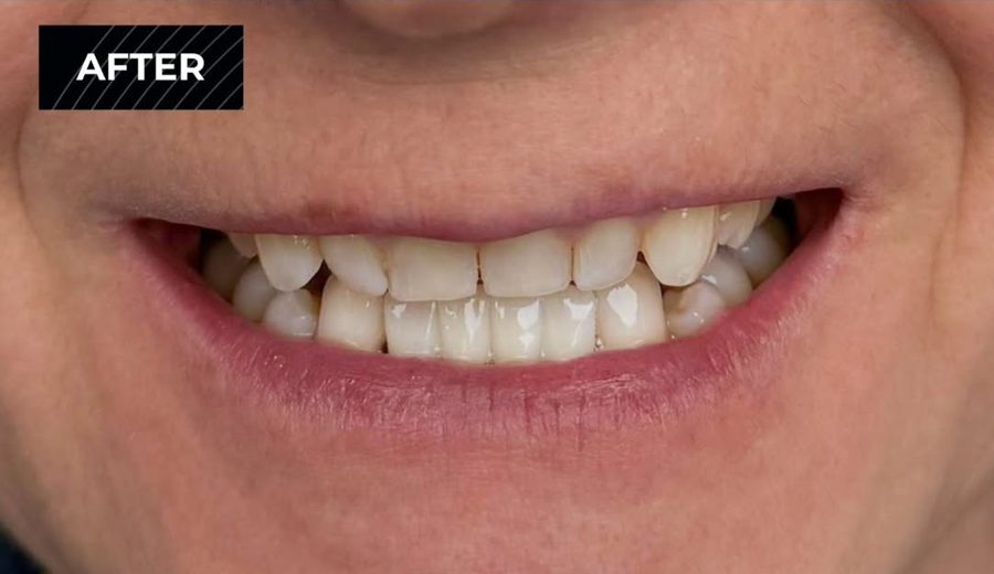 After treatment, Crowded, uneven front teeth aligned and reshaped, Dental Oasis Tirana