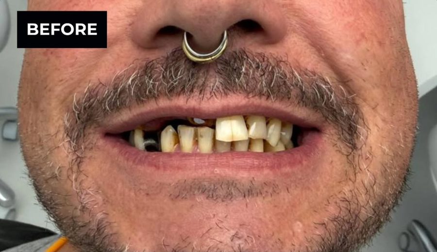 Before treatment, Missing and decayed teeth replaced with implant-supported crowns, Dental Oasis Tirana