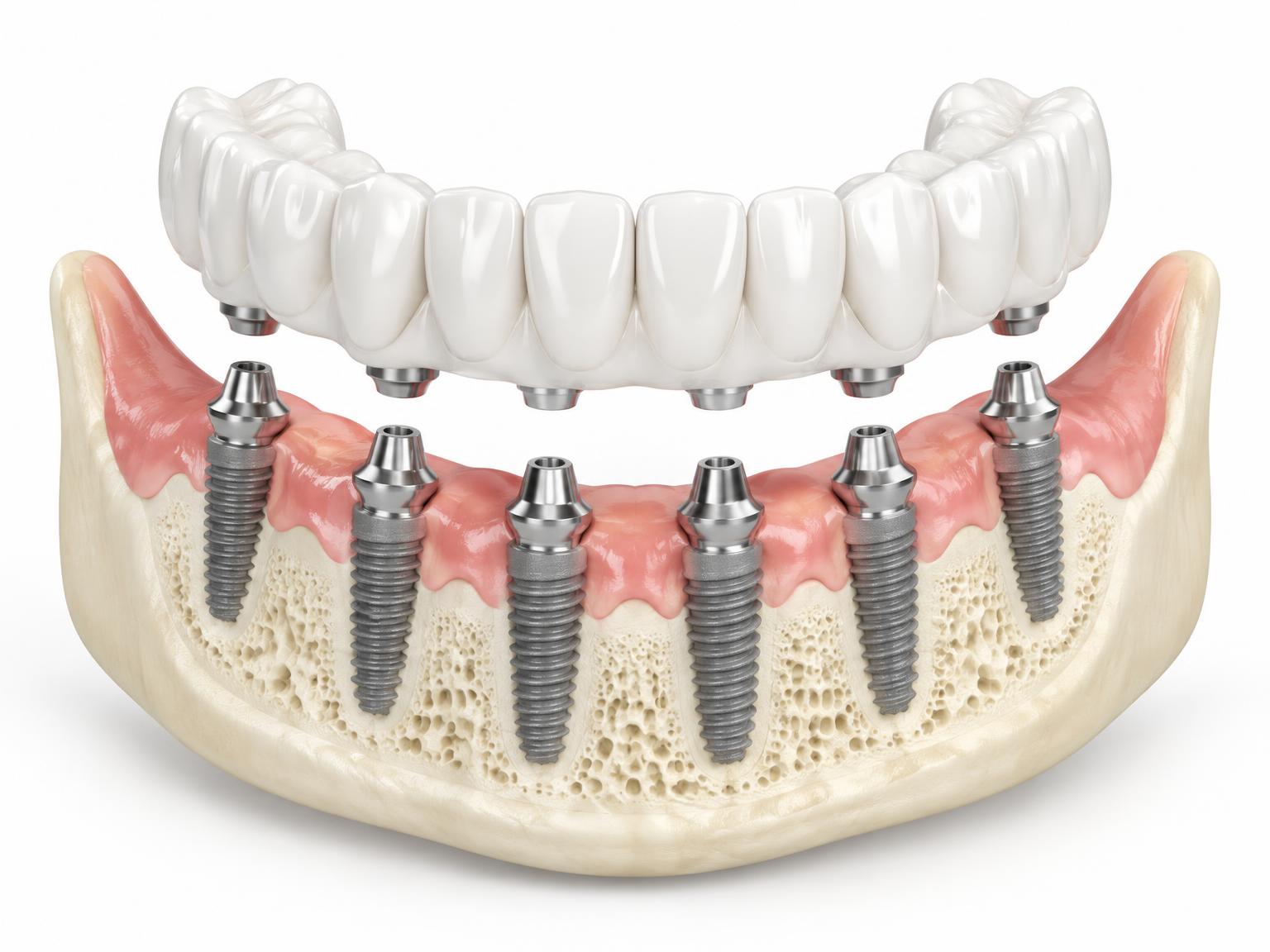Illustration of a full-arch bridge being fitted onto six implants