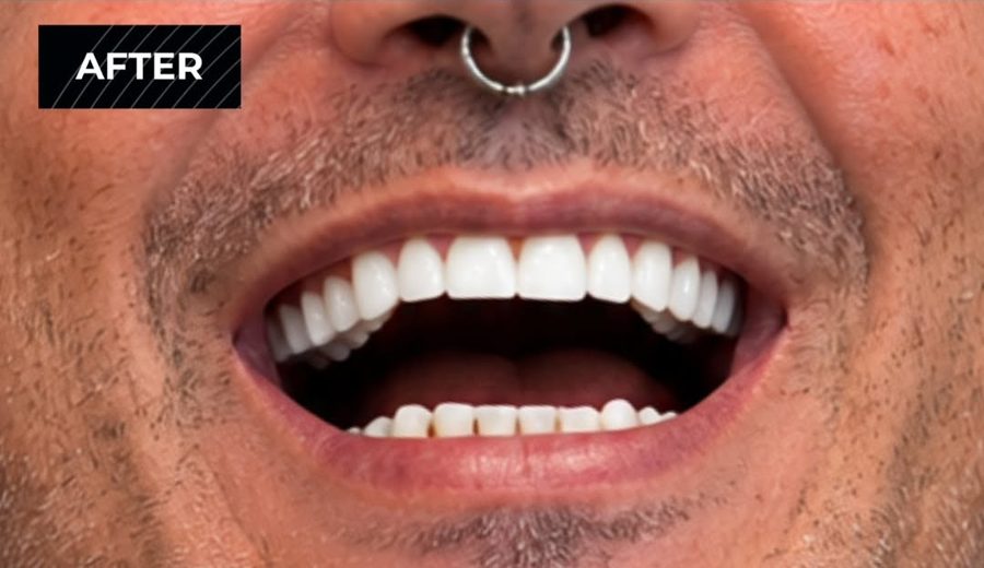 After treatment, Missing and decayed teeth replaced with implant-supported crowns, Dental Oasis Tirana