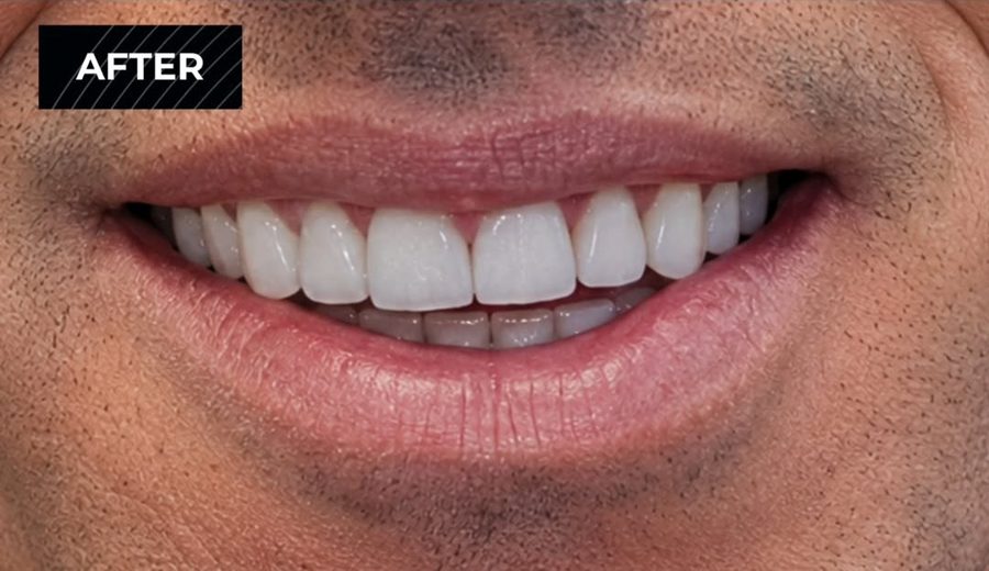 After treatment, Missing front teeth replaced with implants and crowns, Dental Oasis Tirana