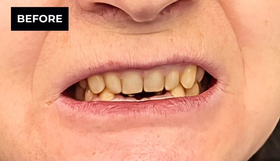 Before treatment, Crowded, uneven front teeth aligned and reshaped, Dental Oasis Tirana