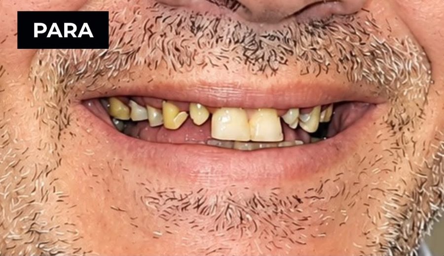 Before treatment, Worn and damaged upper teeth restored with crowns, Dental Oasis Tirana