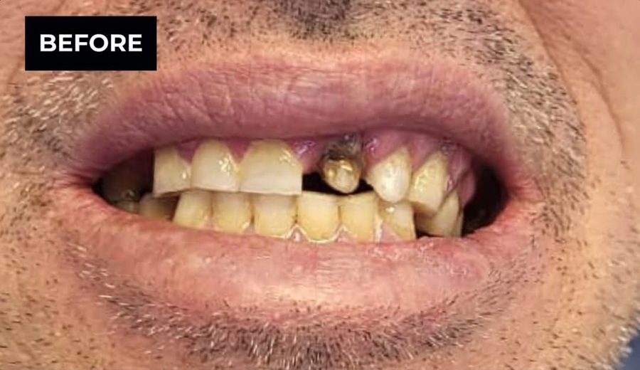Before treatment, Missing front teeth replaced with implants and crowns, Dental Oasis Tirana