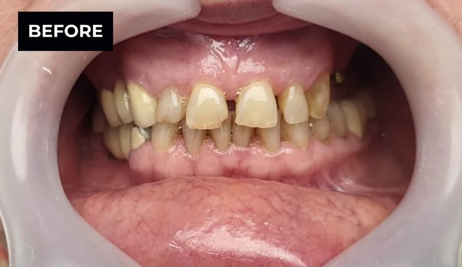 Before treatment, Gaps and worn edges closed with a full veneer set, Dental Oasis Tirana