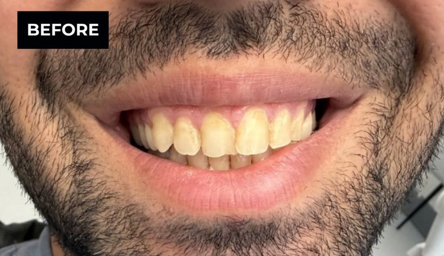 Before treatment, Yellowed smile brightened and evened out, Dental Oasis Tirana