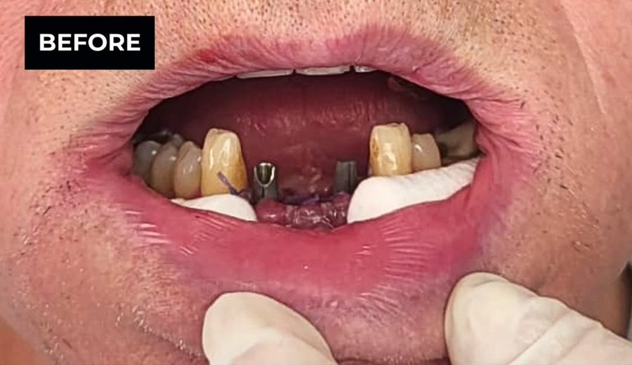 Before treatment, Failing upper arch replaced with a fixed full-arch bridge, Dental Oasis Tirana