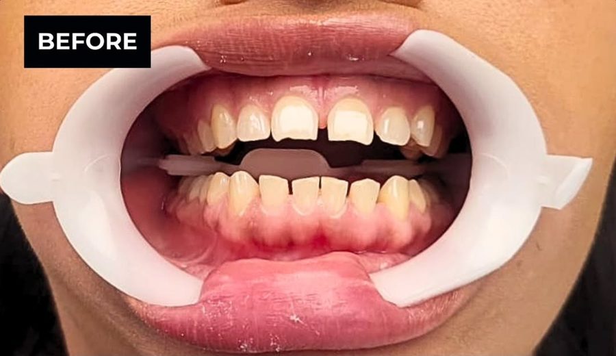 Before treatment, Broken front tooth rebuilt after an emergency visit, Dental Oasis Tirana