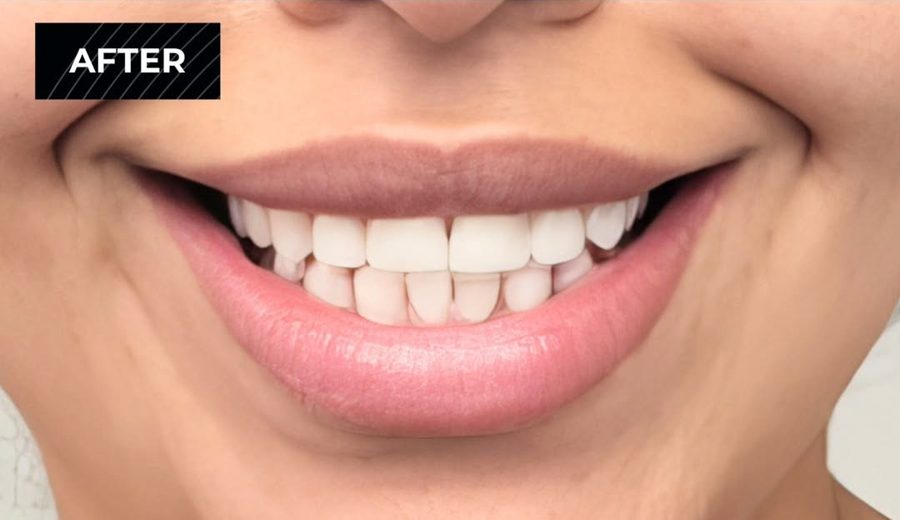 After treatment, Broken front tooth rebuilt after an emergency visit, Dental Oasis Tirana