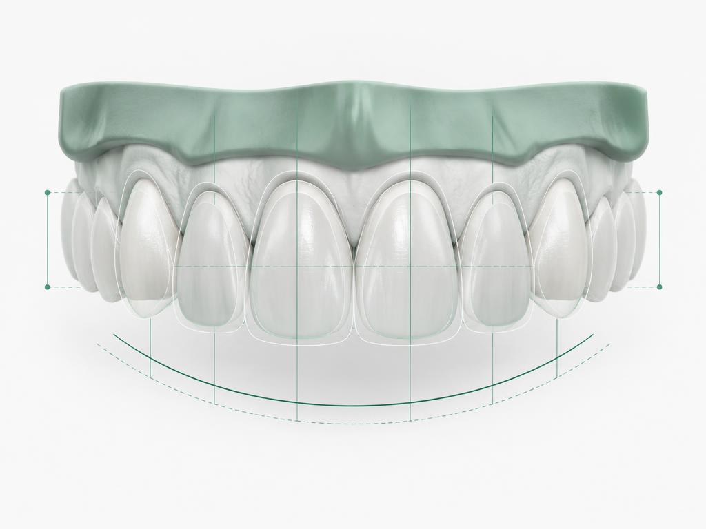 Illustration of front teeth with digital outlines of planned shapes