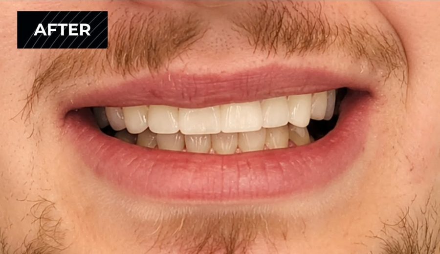 After treatment, Extractions, implants and crowns in one treatment plan, Dental Oasis Tirana