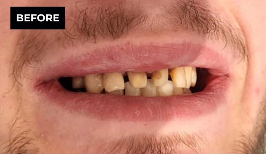 Before treatment, Extractions, implants and crowns in one treatment plan, Dental Oasis Tirana