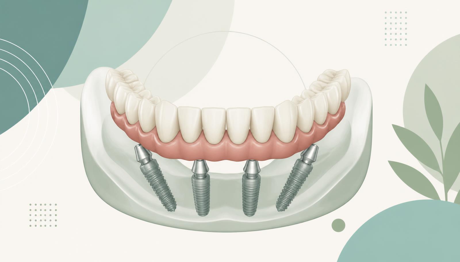 Implant surgery for same-day teeth at a dental clinic in Tirana, Albania