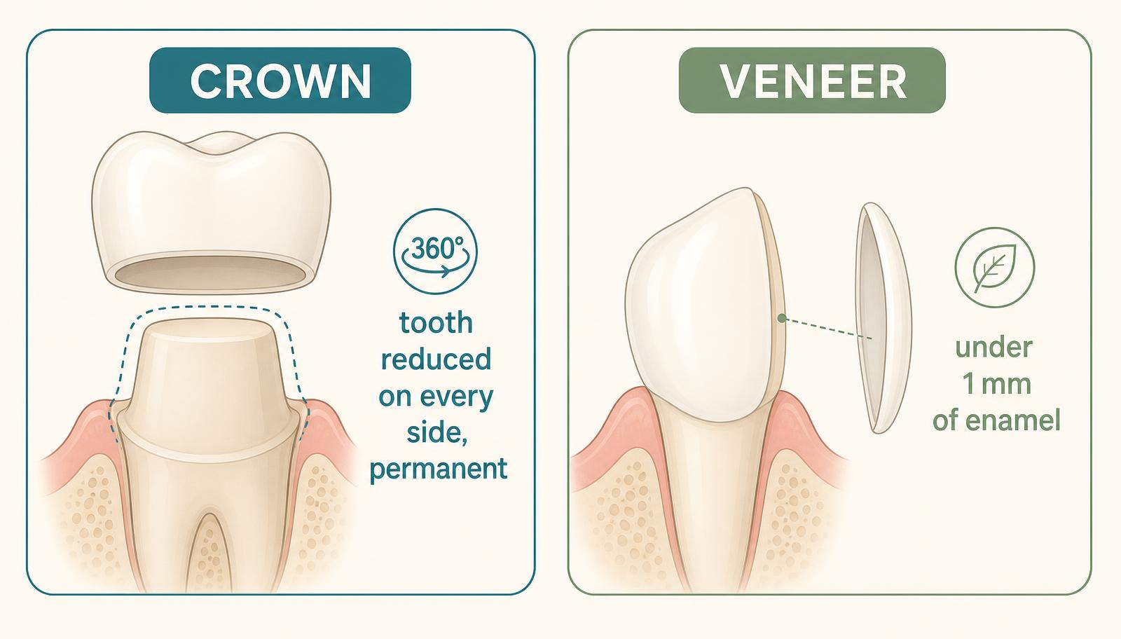 Infographic comparing crown preparation, where the tooth is reduced on every side, with veneer preparation of under one millimetre of enamel