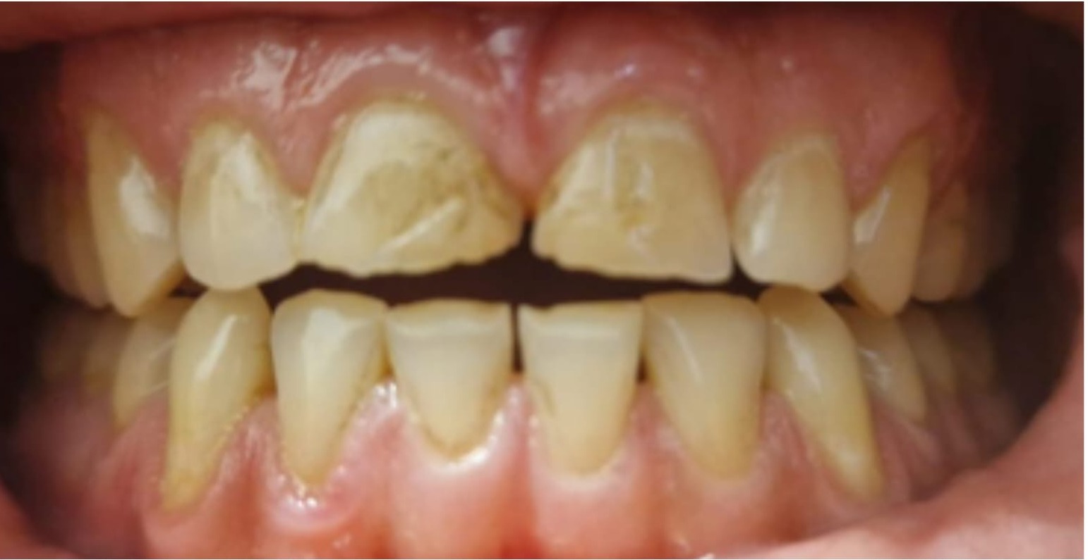 Dental Oasis - Bruxism and grinding teeth symptoms