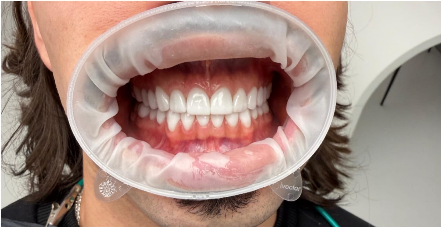Dental Oasis - E-max veneers Inlay and Onlay