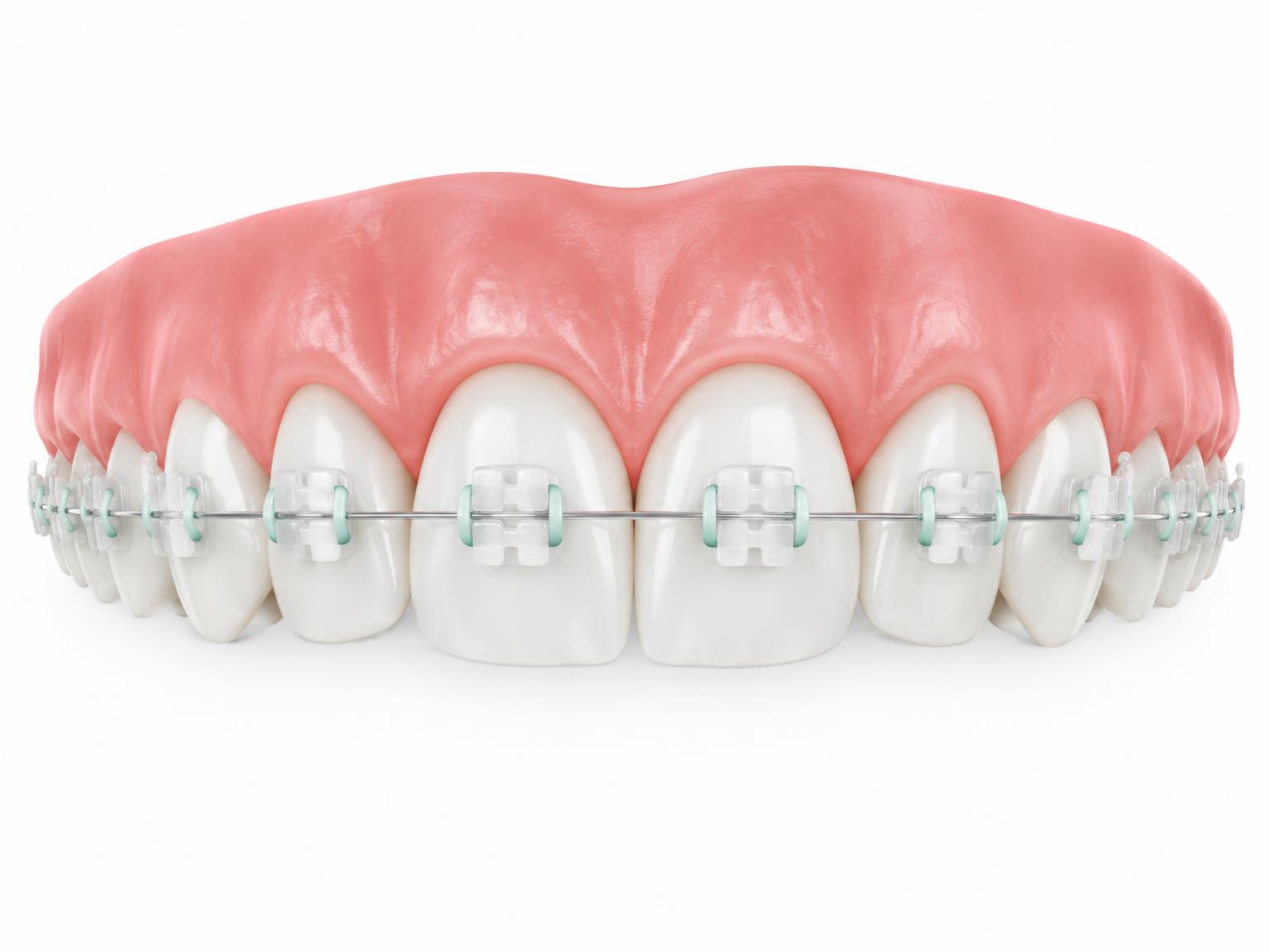 Illustration of upper teeth with discreet ceramic brackets and a thin wire