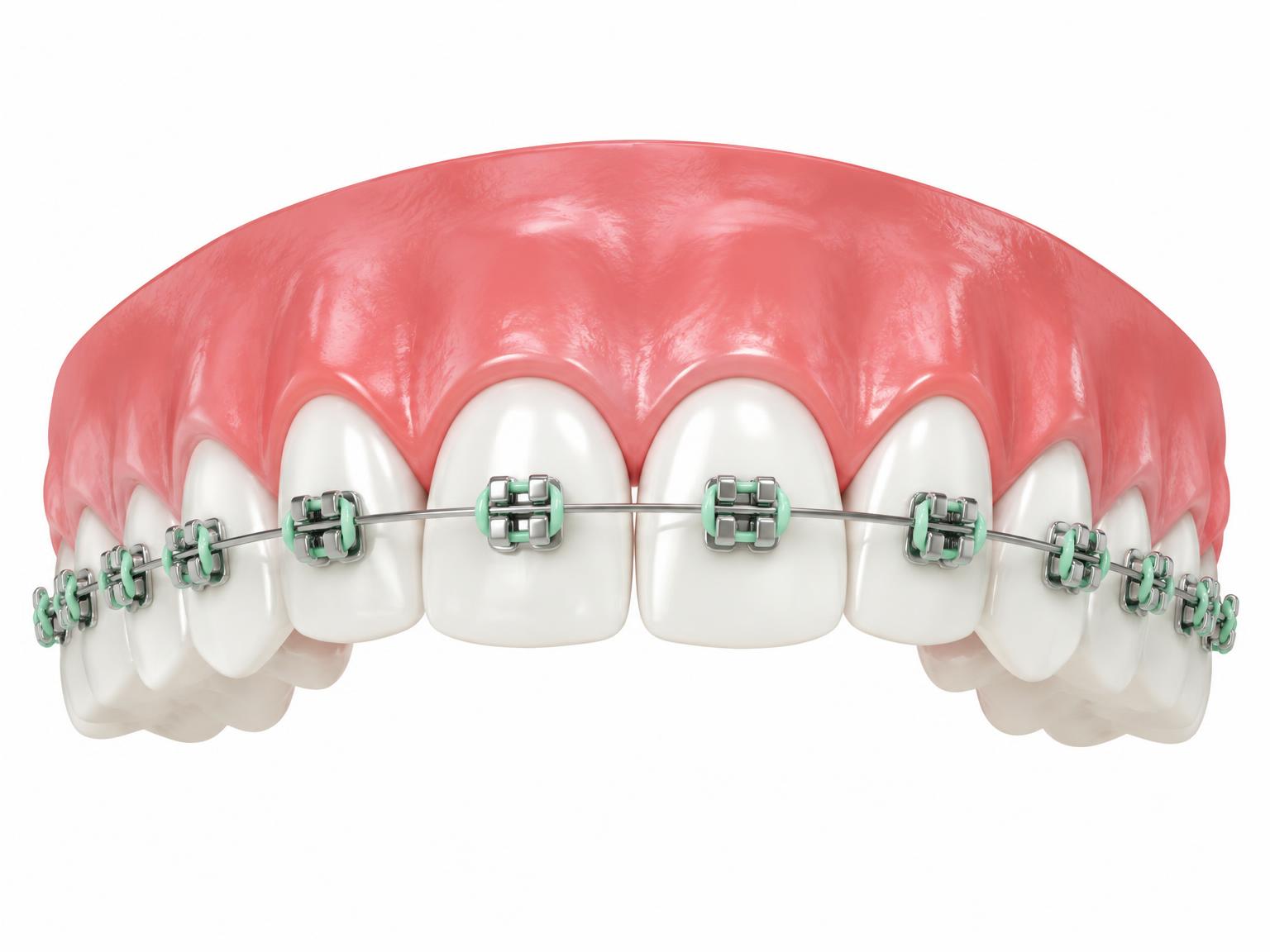 Illustration of upper teeth with metal brackets and an archwire