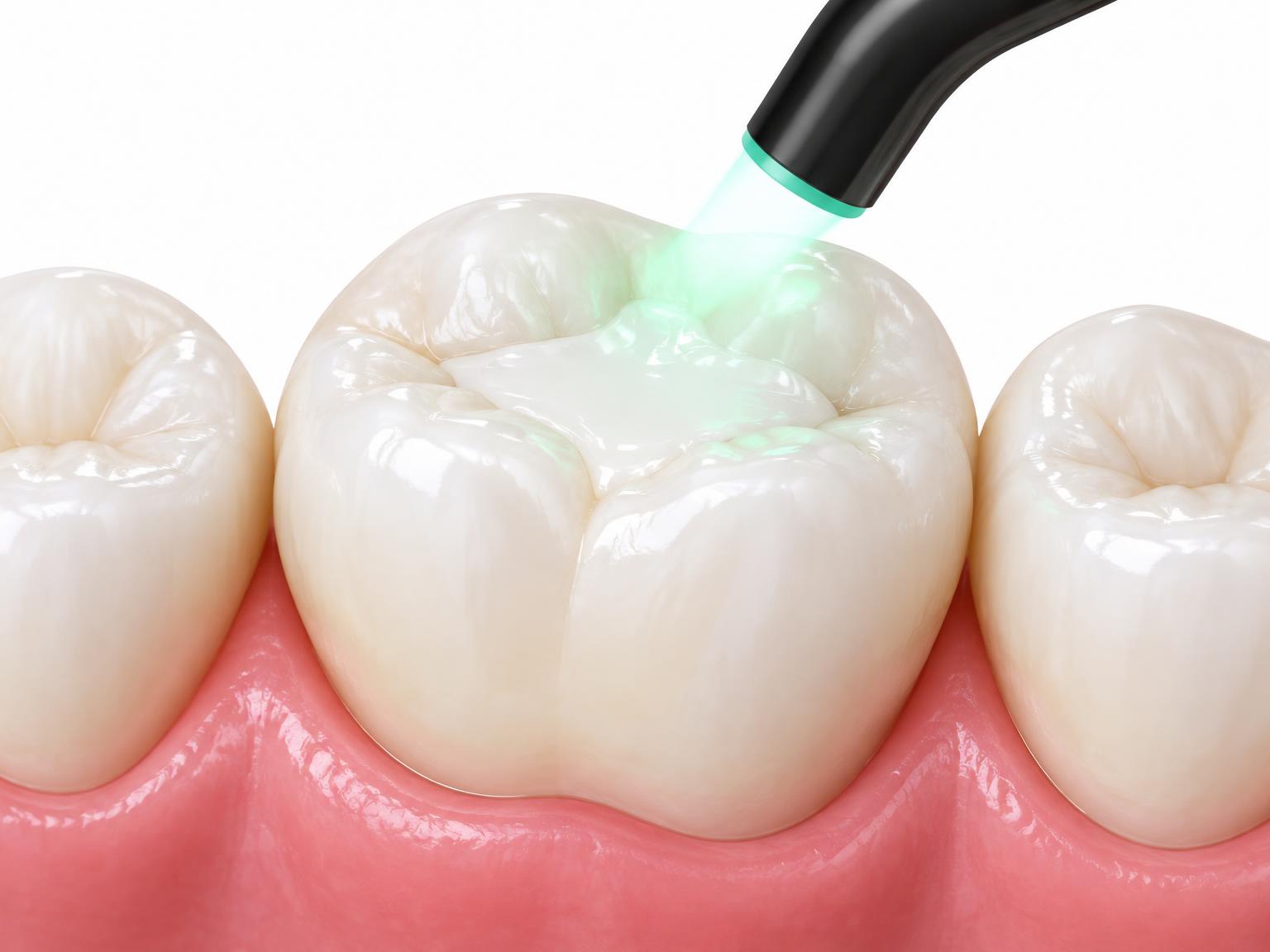 Illustration of a white composite filling being light-cured in a molar