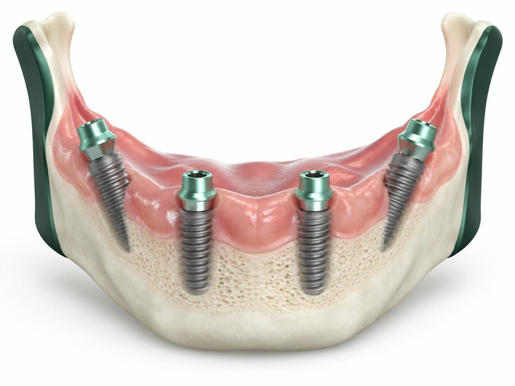 Illustration of four implants in a jaw, the rear two angled
