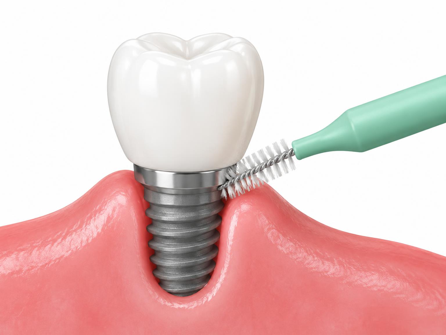 Illustration of an interdental brush cleaning around an implant crown