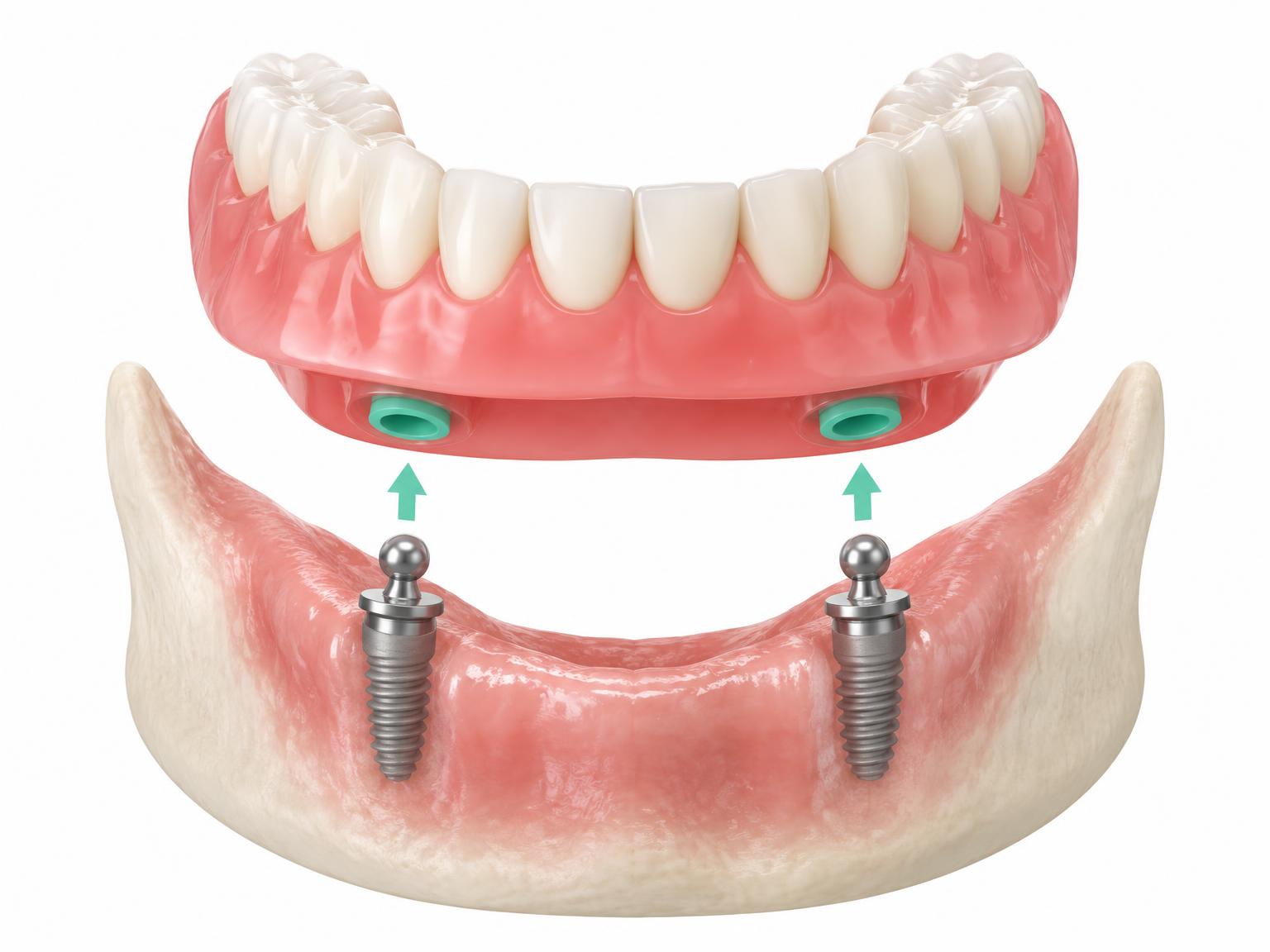 Illustration of a removable denture above two implants with ball attachments