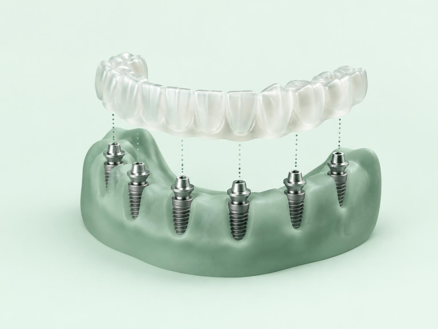 Ilustración de un puente provisional de arcada completa colocado sobre implantes dentales