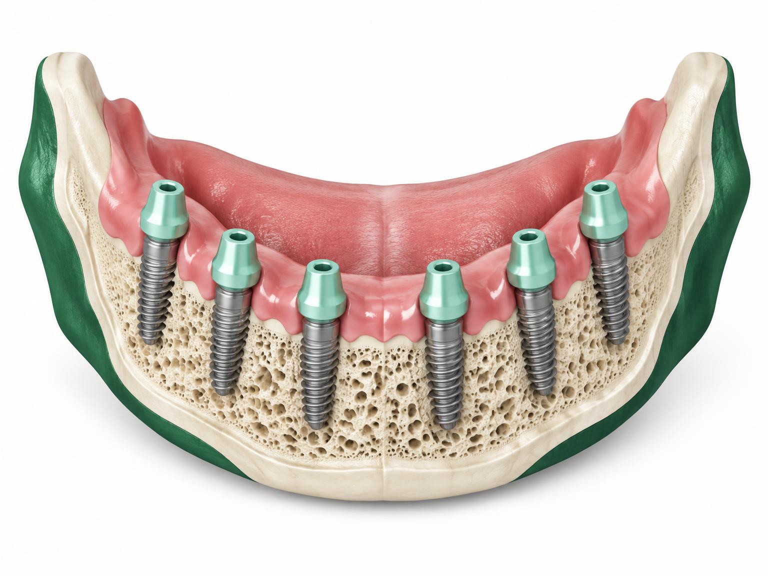 Illustration of six titanium implants evenly spaced in a jaw