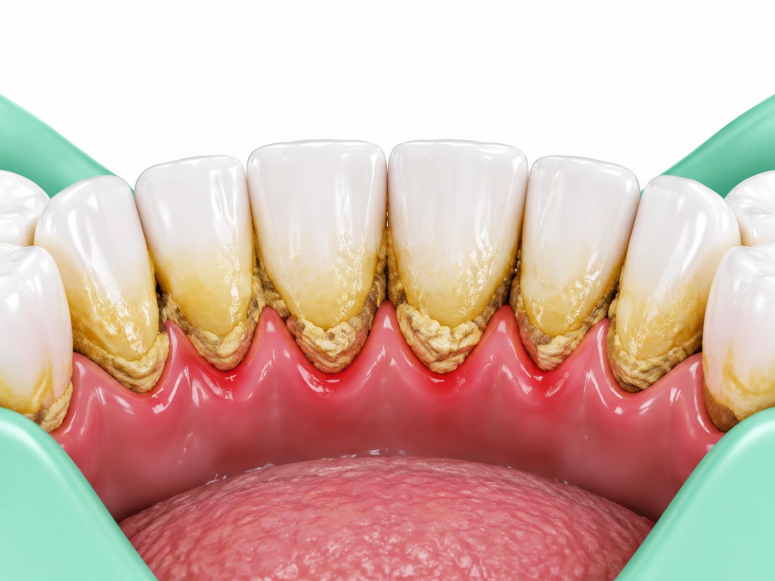 Illustration of tartar deposits along the gum line of lower front teeth