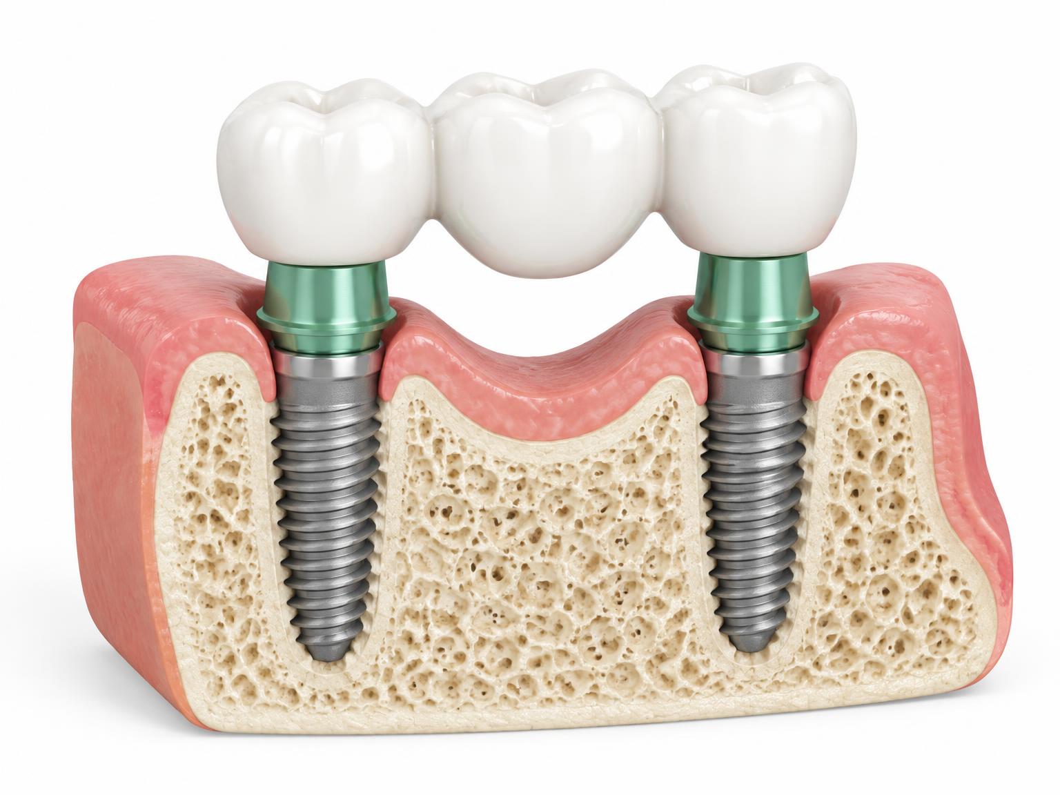 Illustration of a three-tooth bridge supported by two implants