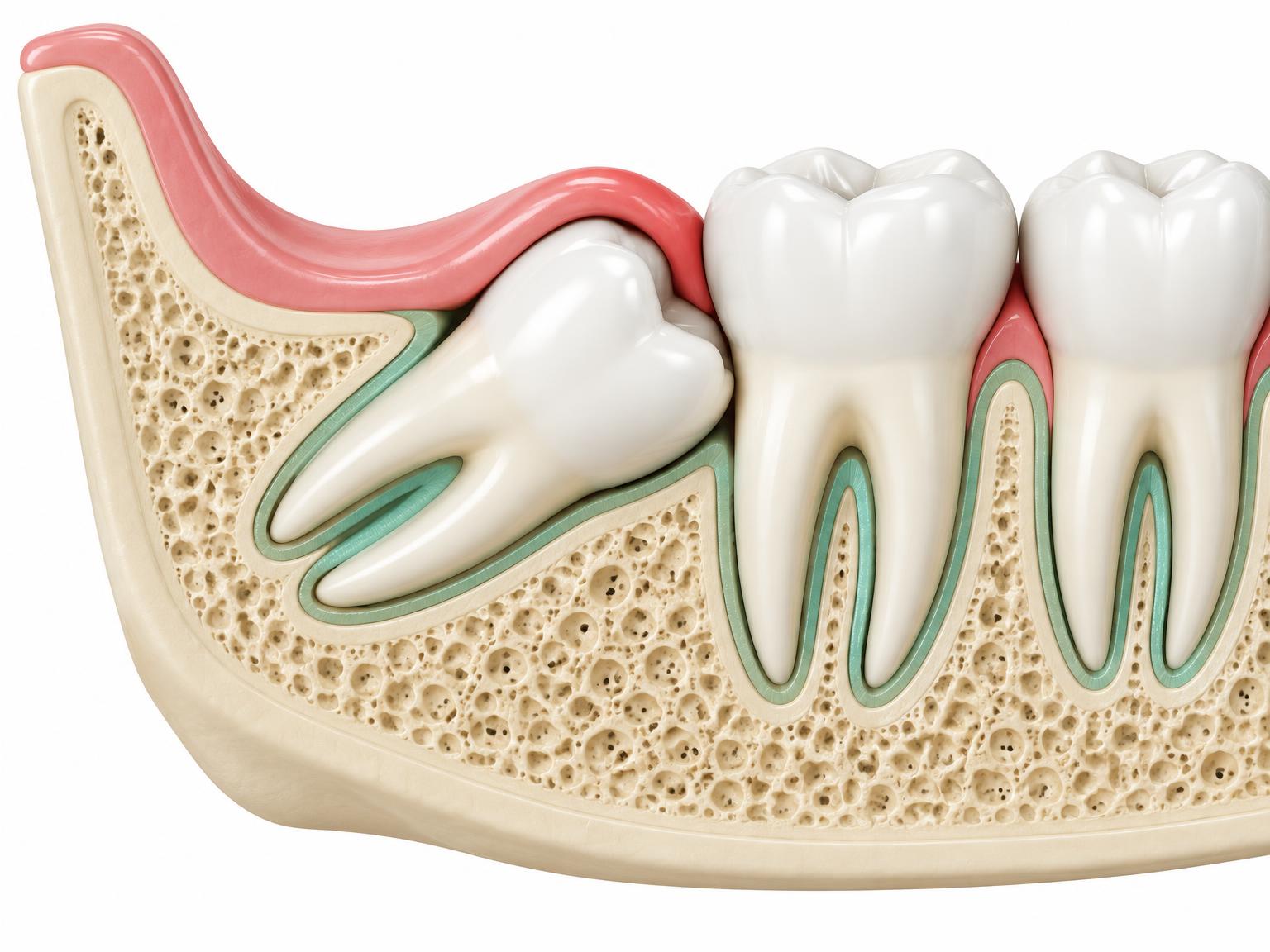 Cross-section illustration of an impacted wisdom tooth angled against the molar